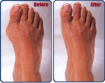 Podiatrist in Oklahoma City | Bunions in Oklahoma City | Dr. Terry M.  Nayfa, D.P.M.